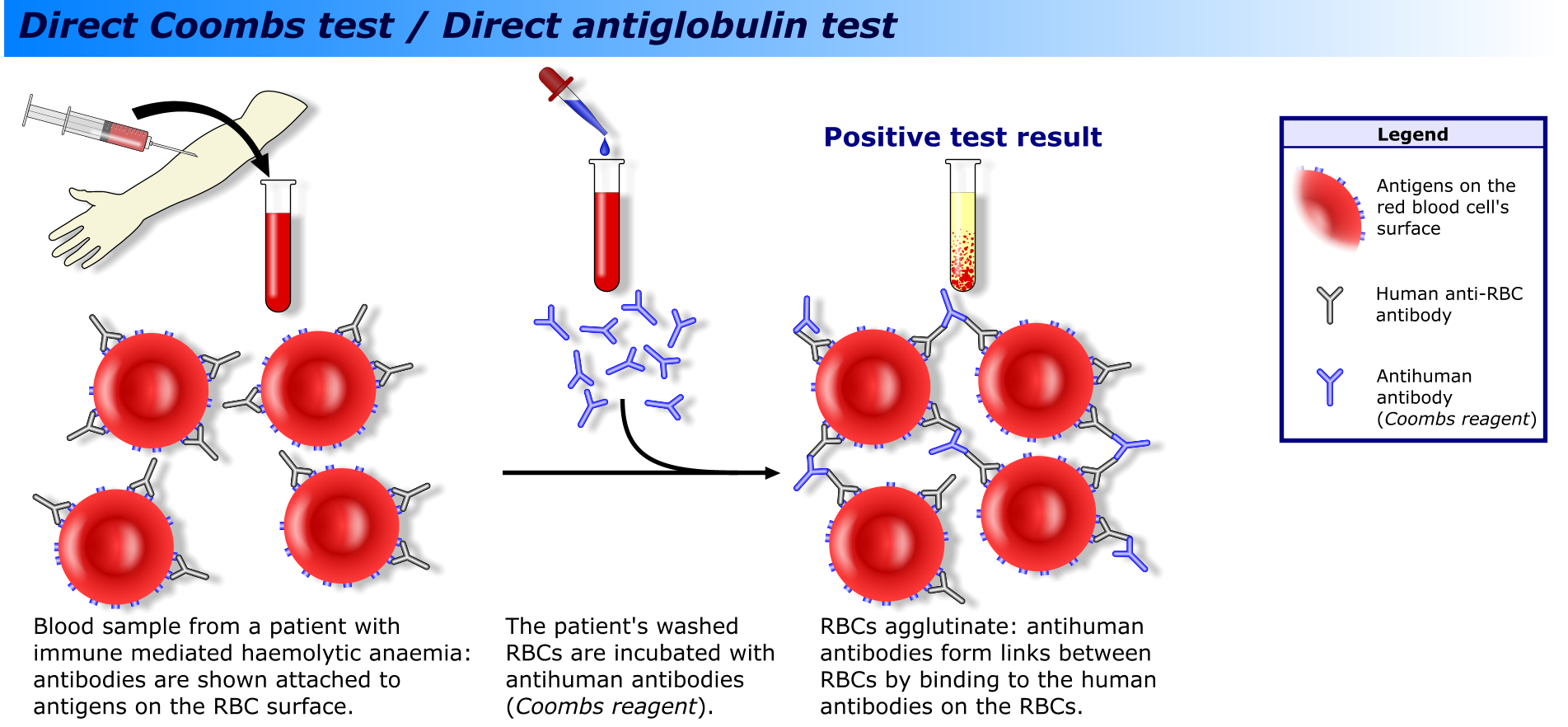 Директен антиглобулинов тест на Кумбс (Coombs)