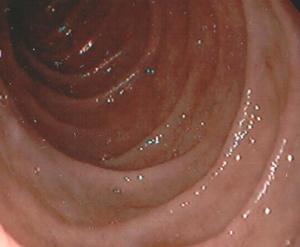 Макроскопска картина на тропическа спру