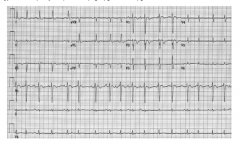 Фигура.1 . ЕКГ при мултифокална предсърдна тахикардия.