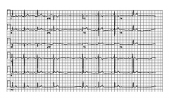 Фигура 12. ЕКГ при тип I Wenckebach блок (Mobitz I).