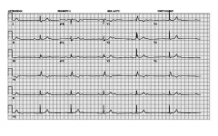 Фигура 13. ЕКГ при MobitzII.