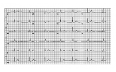 Фигура 14. ЕКГ при AV блок III ст.