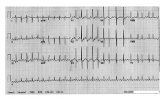 Фигура 2. ЕКГ при предсърдно трептене.