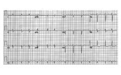 Фигура 3 ЕКГ при предсърдно мъждене