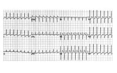 Фигура 4. ЕКГ при AV re-entry тахикардия.