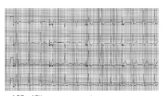 Фигура 5. ЕКГ при WPW синдром.