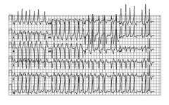 Фигура 6. ЕКГ при WPW синдром и предсърдно мъждене