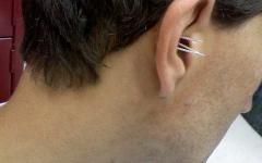 Акупунктура