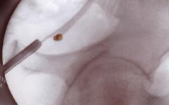 Бъбречен камък