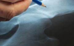 Остеопороза