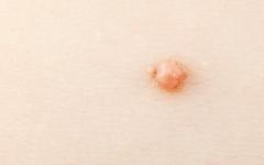 Истинската причина за появата на брадавиците не е напълно ясна Брадавица