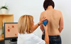 Безцветният меланом е изключително труден за диагностика Меланом