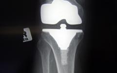 При гонартроза са необходими рехабилитационни процедури поне два пъти в годината Алопластика на колянна става