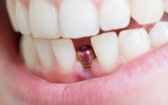 Зъбeн (денталeн) имплант