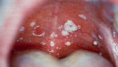 Най-често срещаната форма на орална кандидозна инфекция е острият псевдомембранозен кандидозен стоматит
