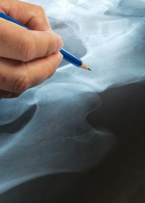 Остеопороза