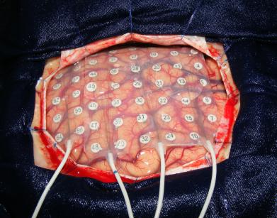 Операцията спасява от гърчовете